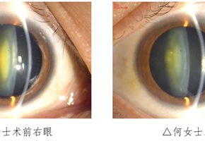 深圳一女子成年之后近视度数一直上涨，竟是得了白内障！