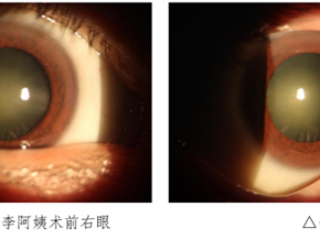 泰酷辣！3D可视化手术系统让她重见清晰视界