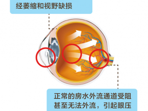 眼睛“太漂亮”，为什么要警惕是先天性青光眼？