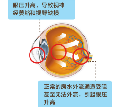 眼睛“太漂亮”，为什么要警惕是先天性青光眼？